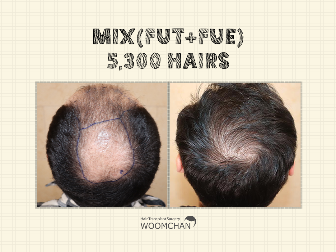 Mix(FUT+FUE) 5,300 hairs after 12 months