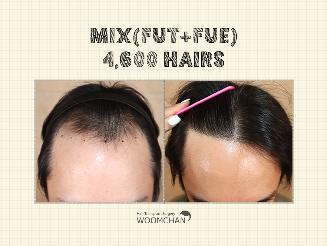 Mix(FUT+FUE) 4,600 hairs after 10 months